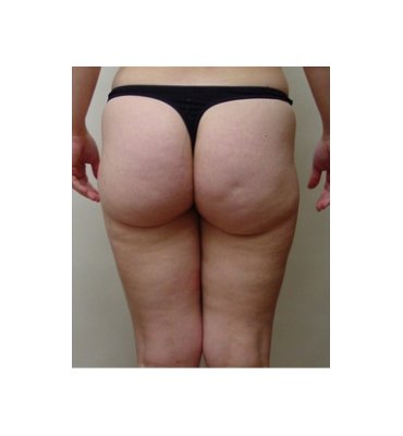 Buttock And Liposuction After