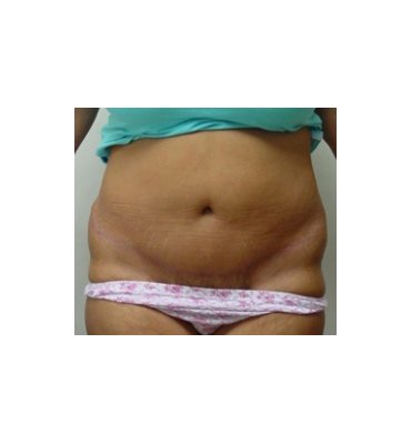 Stretch Marks & Abdominoplasty After