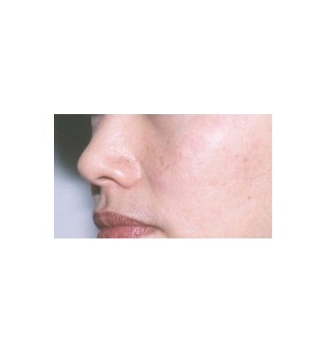 Shave Excision For Hyperpigmentation After