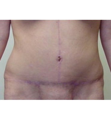 Fleur-De-Lis Abdominoplasty After