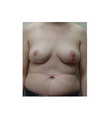 Scar Revision With Umbilicoplasty After