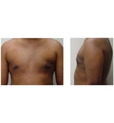 Natural Results From Gynecomastia Surgery After