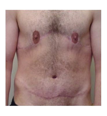 Body Lift With Gynecomastia Correction After