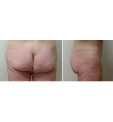 Infra Gluteal Buttock Lift After