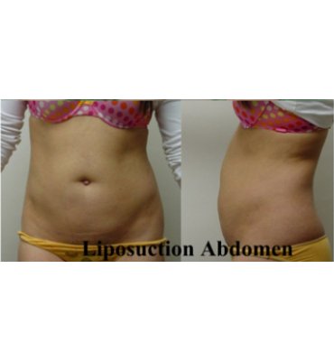 Abdominal Liposuction After