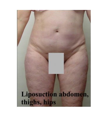 Liposuction And Cellulite After
