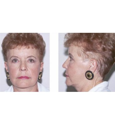 Easy Facial Rejuvenation Procedures After
