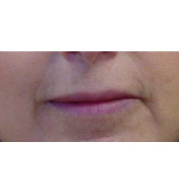 Dermal Fat Graft Surgery After