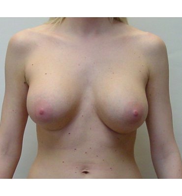 breast augmentaion before