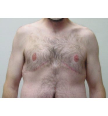 Gynecomastia Surgery in Toronto