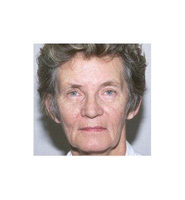 Temporal Brow Lift-Scar After