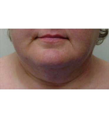 Liposuction For Jaw & Neckline After