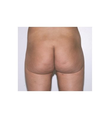 Liposuction Buttocks & Thighs After