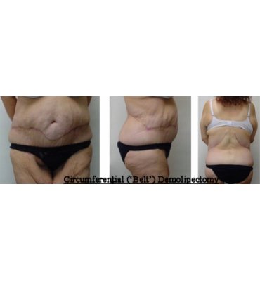 Circumferential Body Lift After