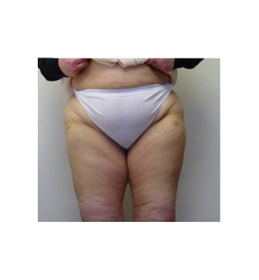 Thigh Lift Vs. Liposuction After
