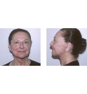 -Simplified Facial Rejuvenation Procedures After