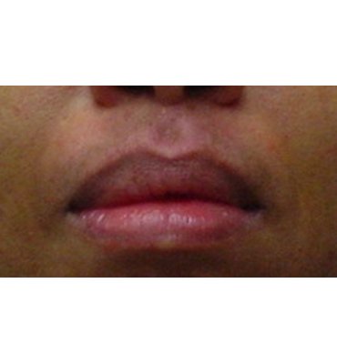 dark skin pigmentation  after