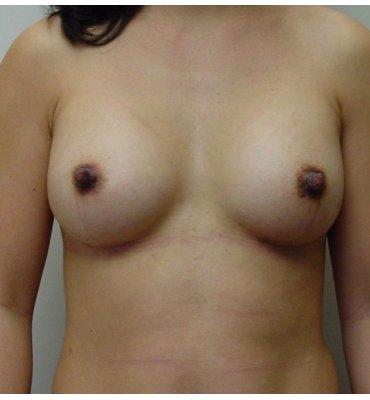 breast augmentation scar avoided by using armpit incision