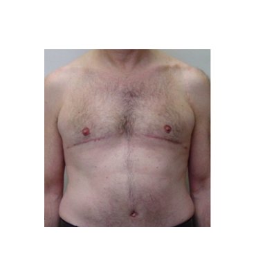 Skin Excision In Gynecomastia After