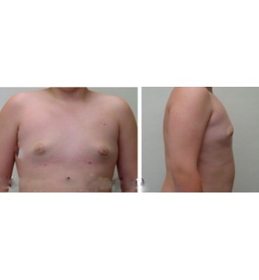 Skin Elasticity & Gynecomastia After