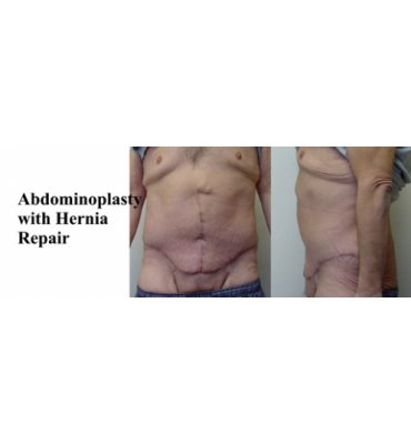 Hernia Repair And Abdominoplasty After