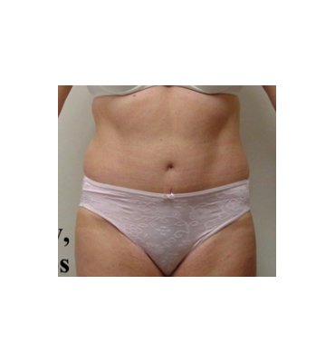 Tummy Tuck With Liposuction After