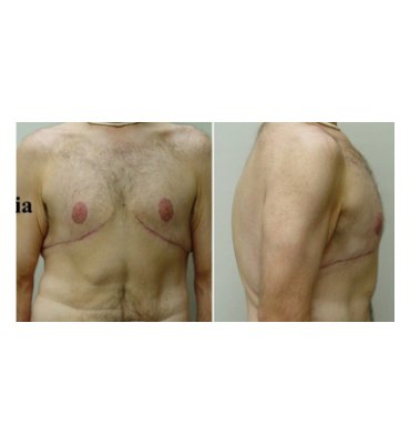 Cutis Pleonasmus & Male Breast Reduction After