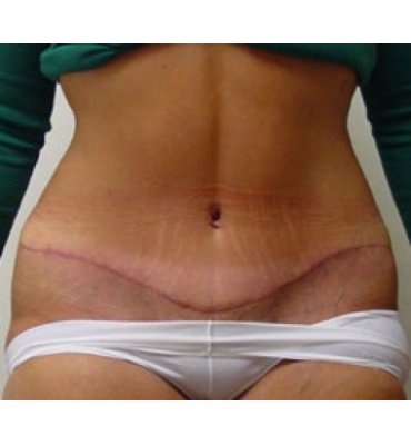 After Abdominoplasty