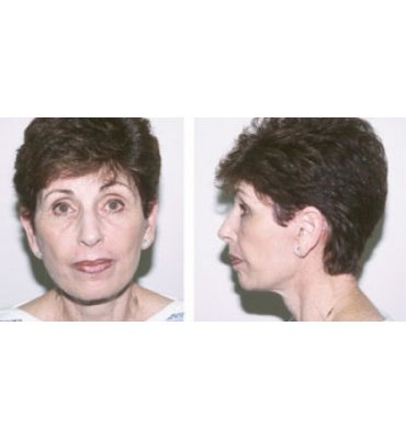 Effective Facial Rejuvenation Surgery After