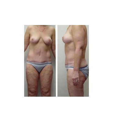 Combination Cosmetic Body Contour Surgery After