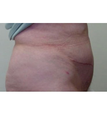 Abdominoplasty Including Fascial Repair After