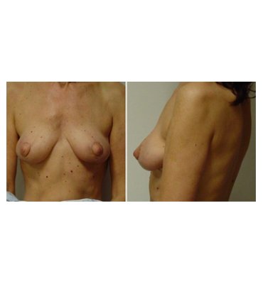 Breast Implant Removal & Mastopexy After