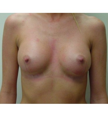 breast augmentaion post