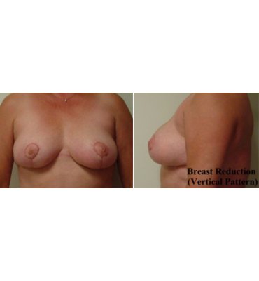 Breast Lift/Mastopexy After
