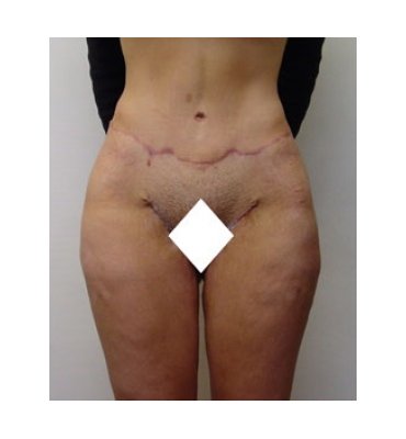 Combination Medial Thigh Lift & Abdominoplasty After