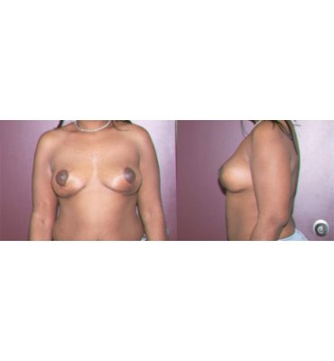Implant Removal & Mastopexy After