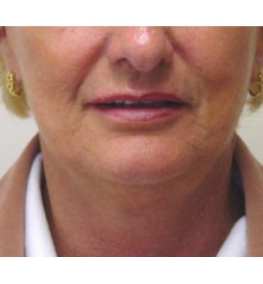 Facial Rejuvenation For Aged Women After