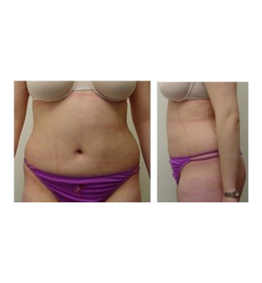 After Abdominal Liposuction