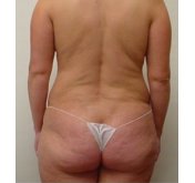 After Liposuction