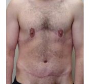 Male Breast Reduction After Weight Loss