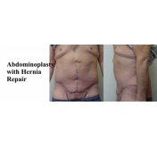 Hernia Repair And Abdominoplasty After