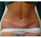 After Abdominoplasty