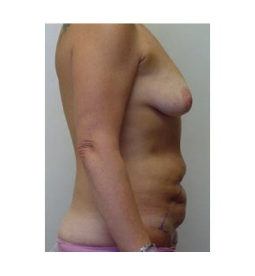 Combined Tummy Tuck And Breast Augmentation Surgery Before