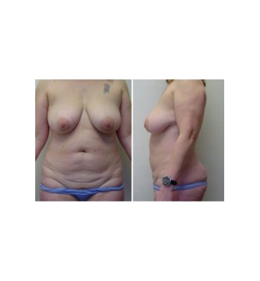 Mastopexy And Abdominoplasty Before