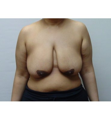 breast lift