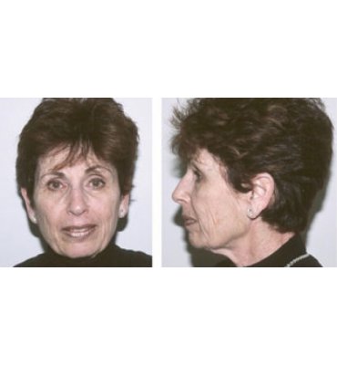 Effective Facial Rejuvenation Surgery Before