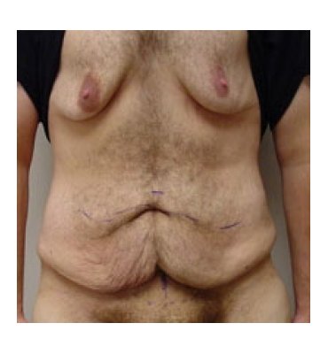 Body Lift With Gynecomastia Correction Before