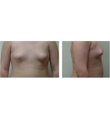 Skin Elasticity & Gynecomastia Before