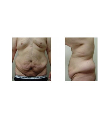 Body Contour Surgery-Single Stage Before
