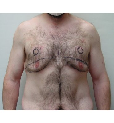 gynecomastia